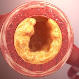 prevent and heal clogged arteries