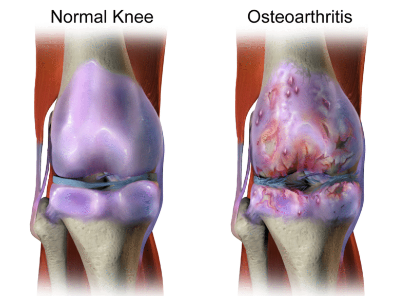 Arthritis as osteoarthritis in a knee joint