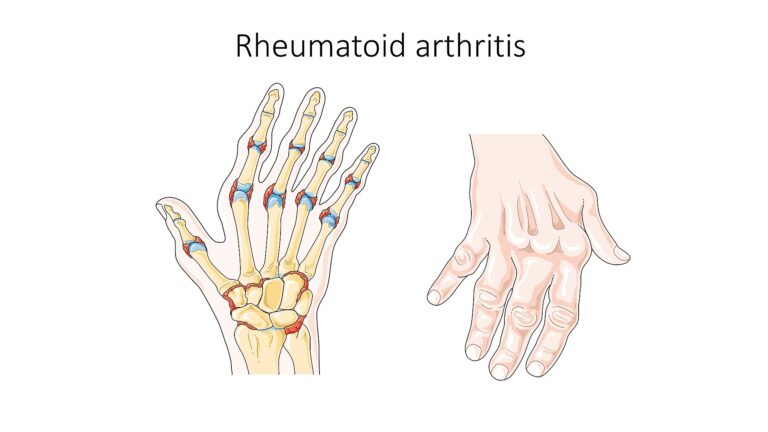 Hand joints with rheumatoid arthritis